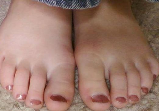 gombás fertőzés bőrkeményedés lábgomba lábgomba gomba a köröm alatt gyalog, hogyan kell kezelni